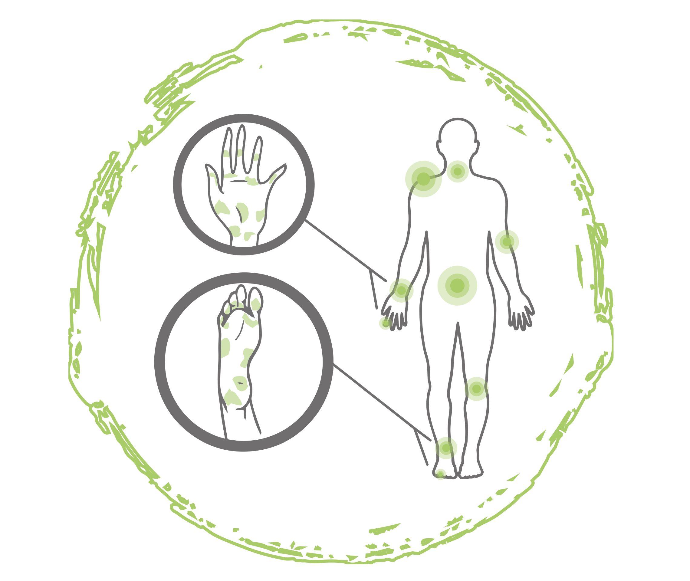 Psoriasis an Hand und Füßen