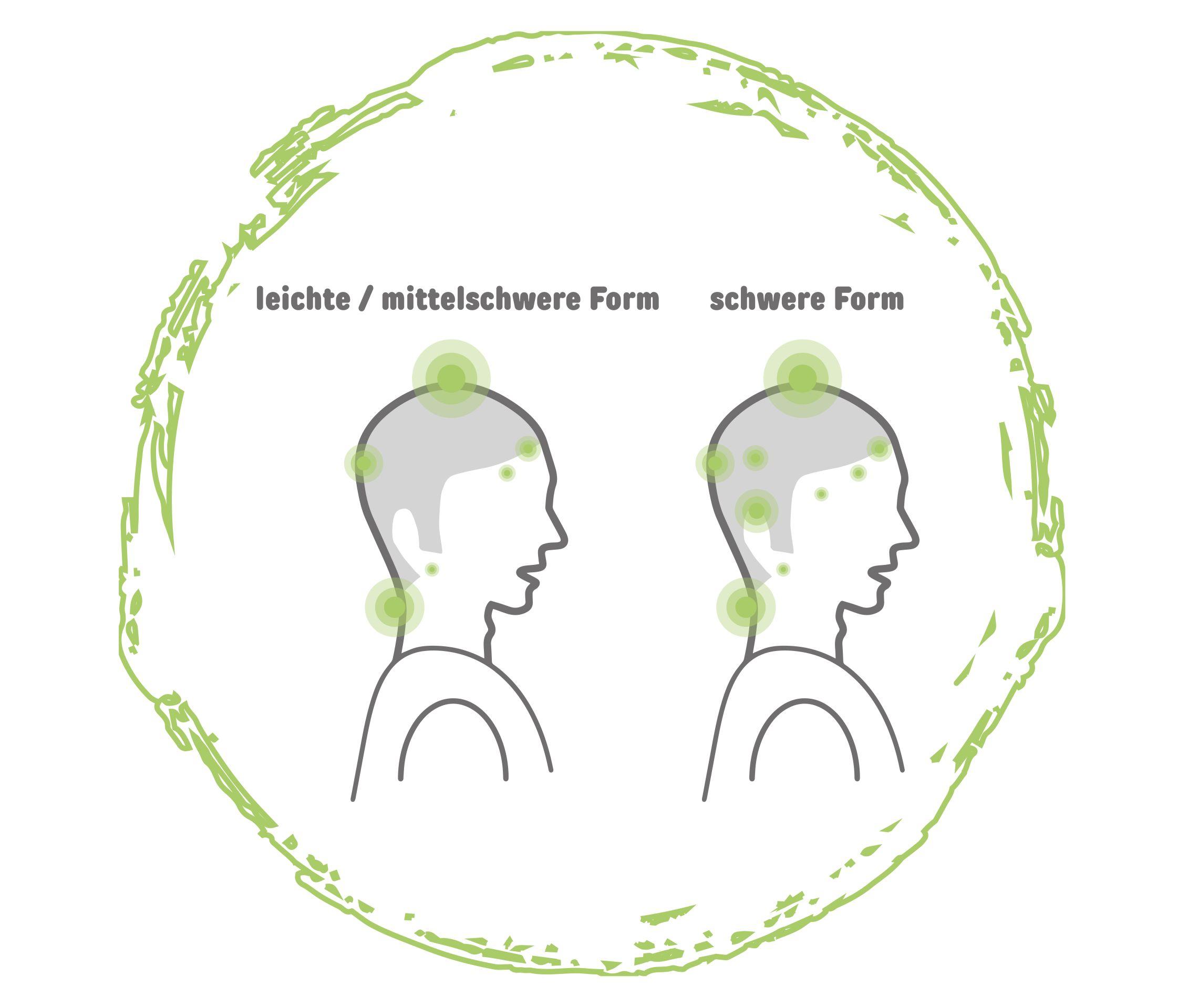 Psoriasis Formen Psoriasis Kopfhaut Grafik 2