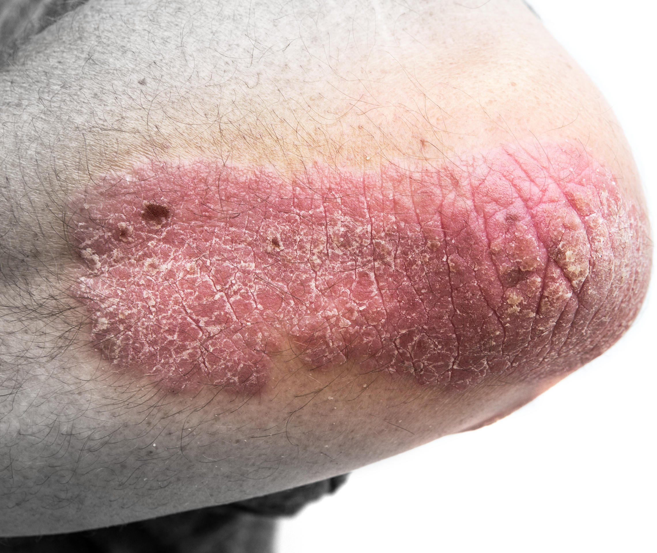 Psoriasis Info Diagnose Schuppenflechte Ellenbogen