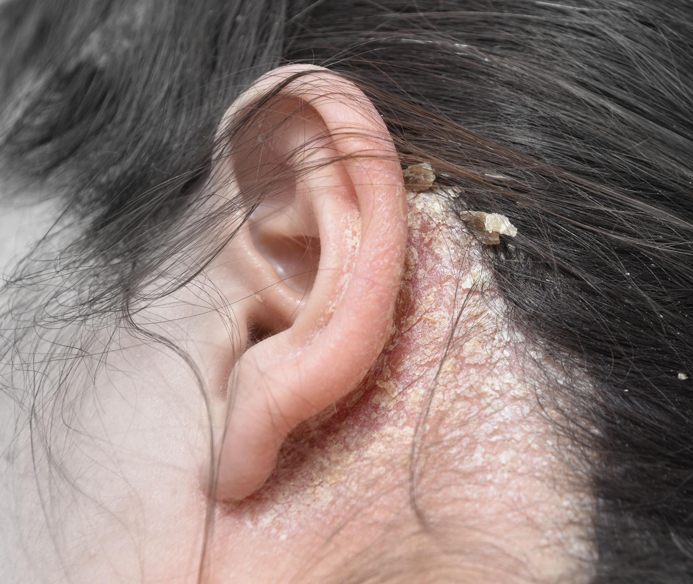 Psoriasis Formen Psoriasis Kopfhaut Schuppen hinter dem Ohr