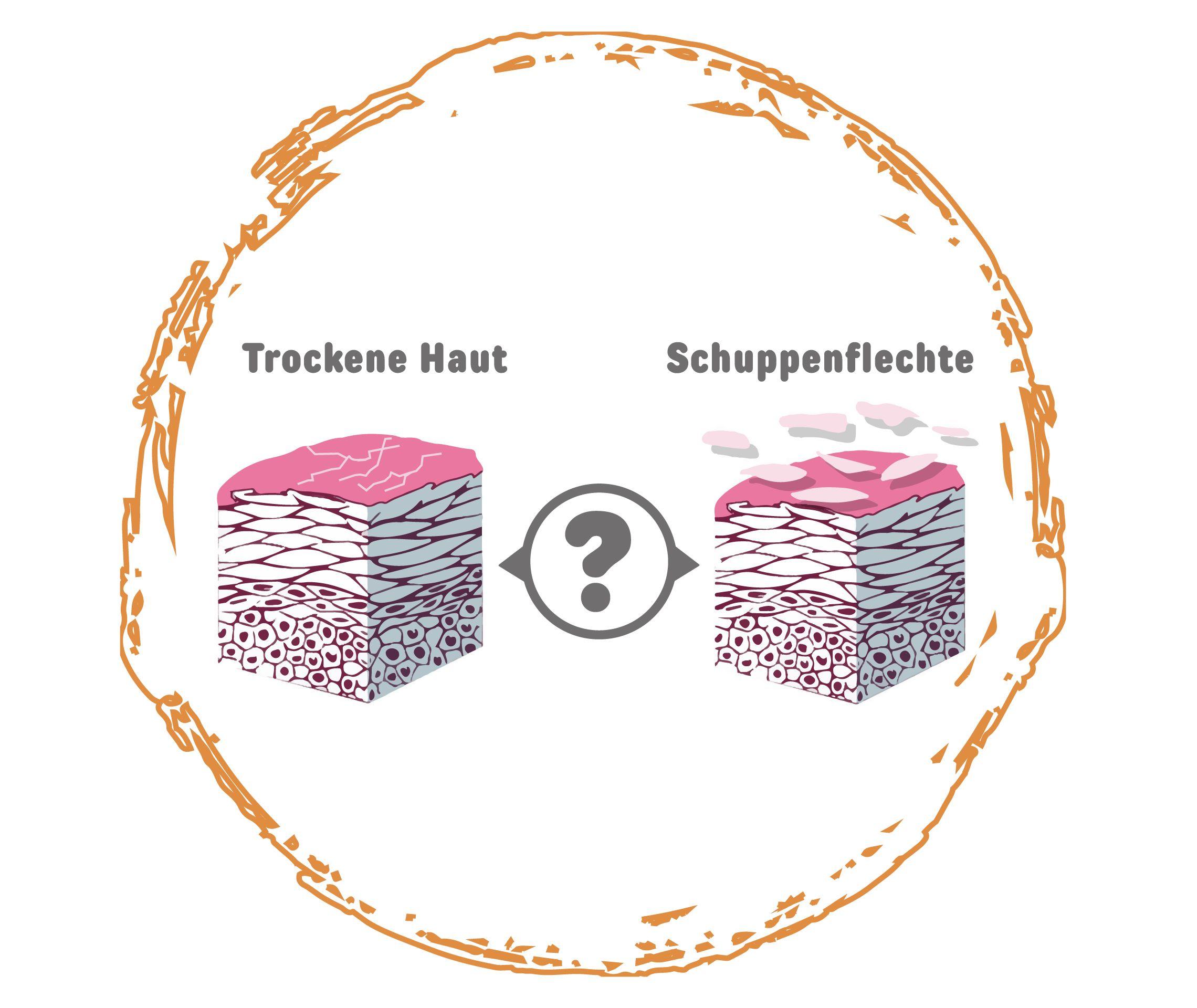 Psoriasis Info Diagnose Schuppen oder Schuppenflechte Grafik 3