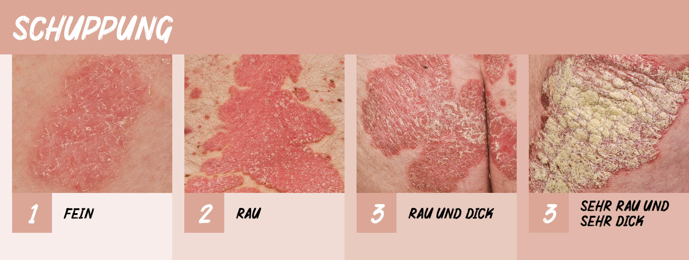 Beispiele für die PASI- Bewertung der Schuppenbildung bei der Psoriasis -Diagnose.