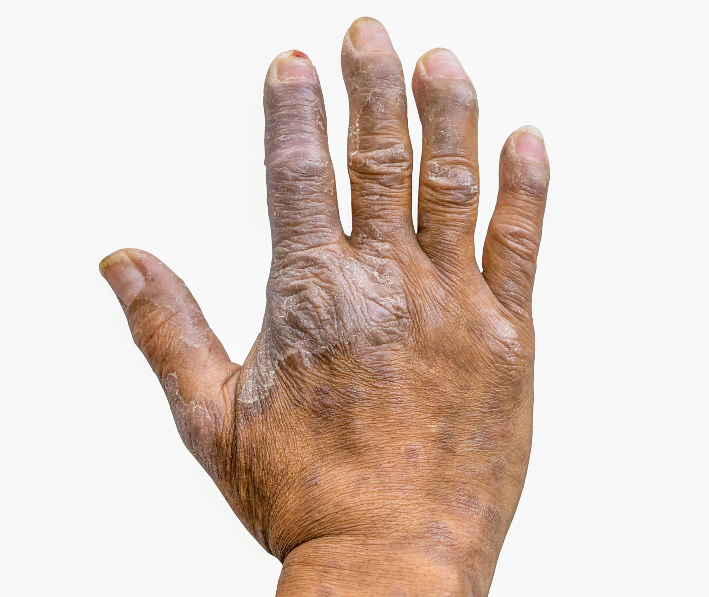 Psoriasis Info Symptome Nagelpsoriasis