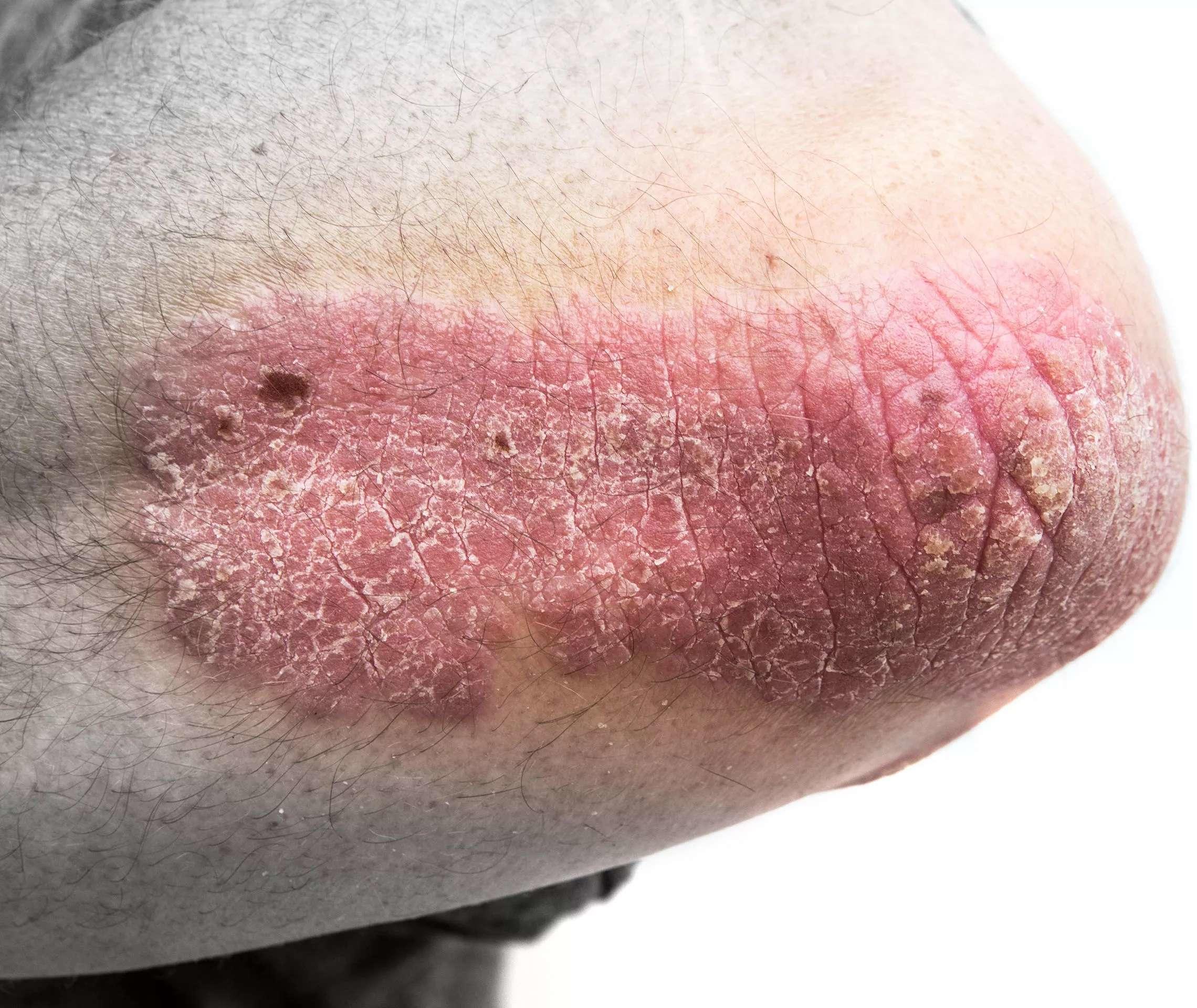 Psoriasis Info Diagnose Schuppenflechte Ellenbogen