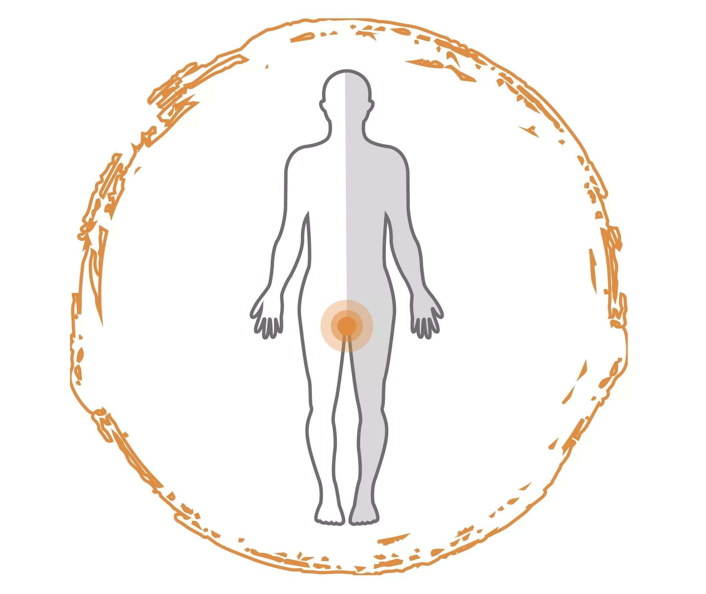 Grafik Person mit Psoriasis im Genitalbereich