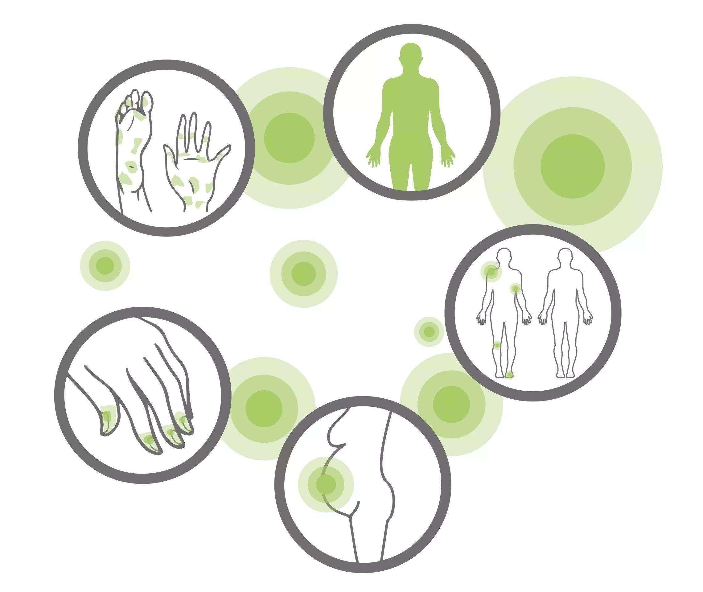 Unterformen von Psoriasis pustulosa