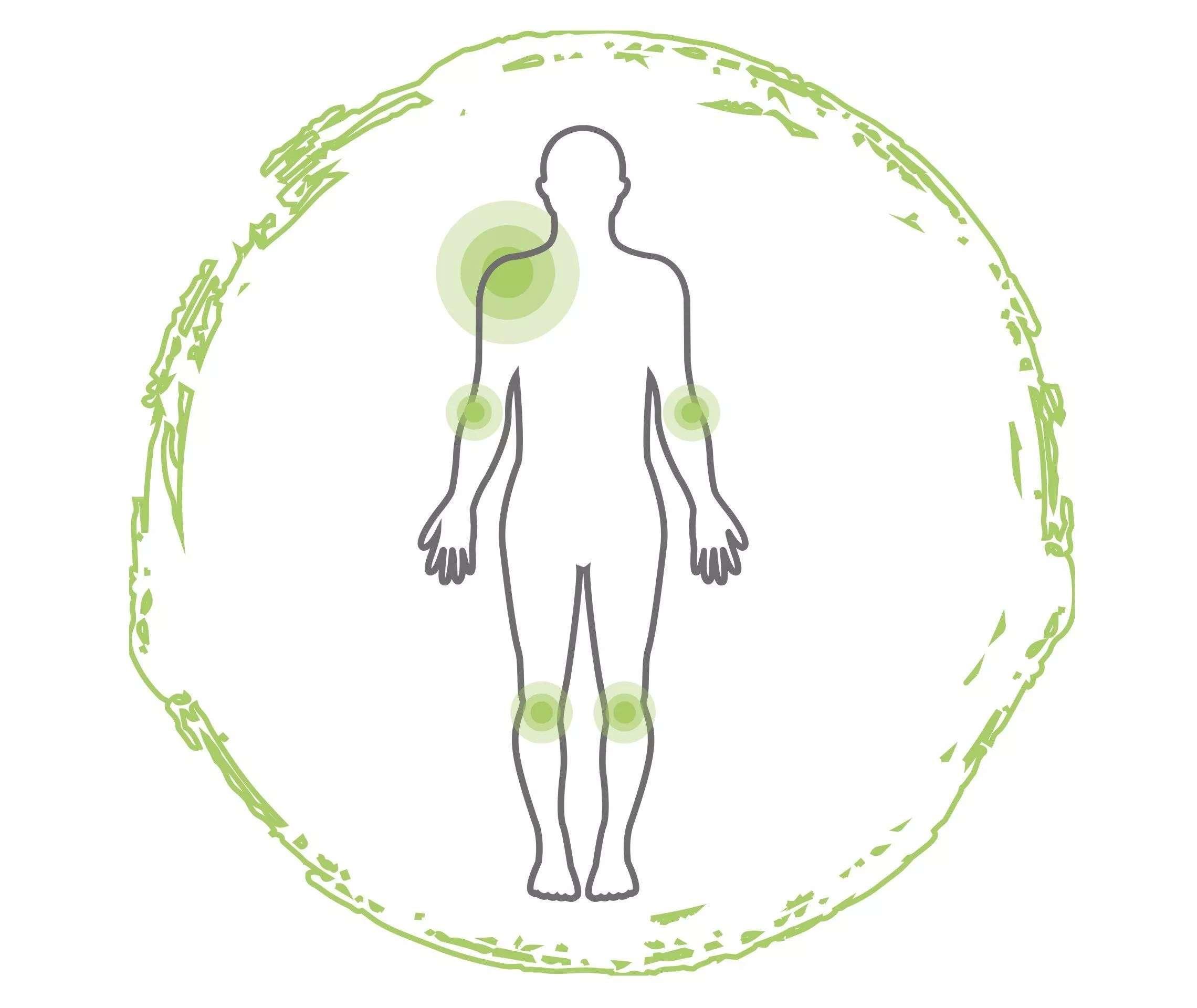 Psoriasis vulgaris - Hier tritt die Plaque-Psoriasis am häufigsten auf