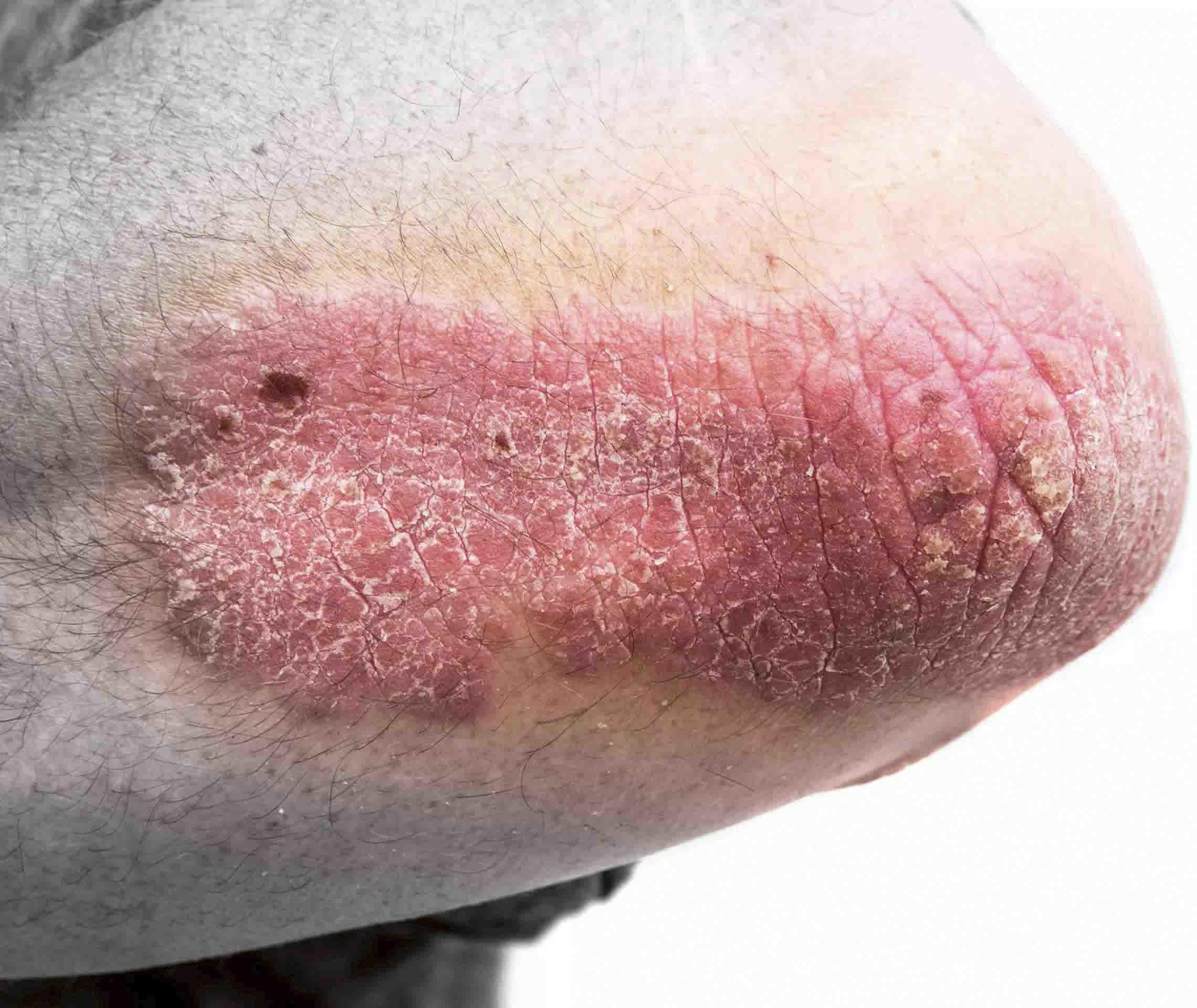 Psoriasis Info Diagnose Schuppenflechte Ellenbogen
