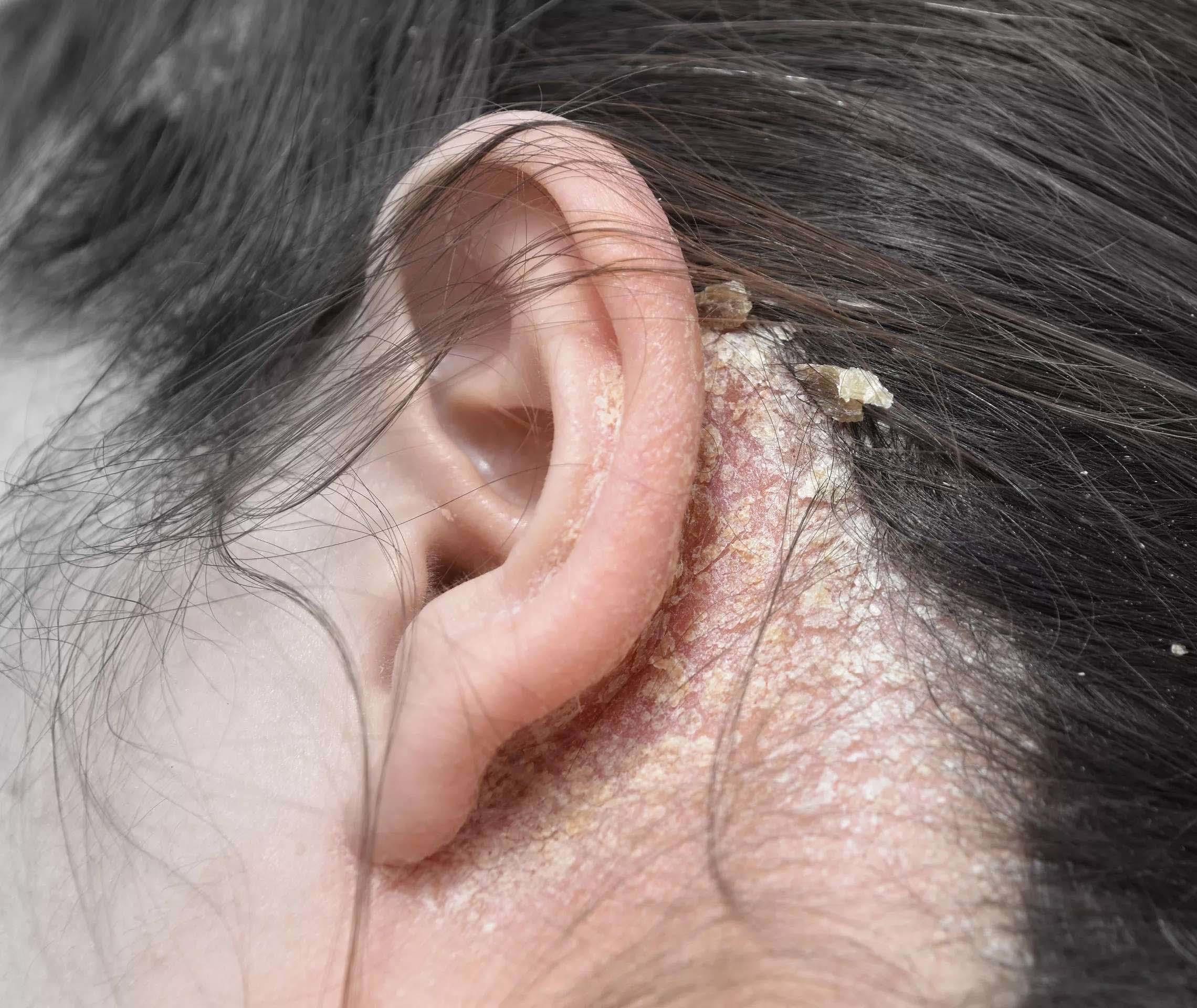 Schuppenflechte Auf Der Kopfhaut Psoriasis Info