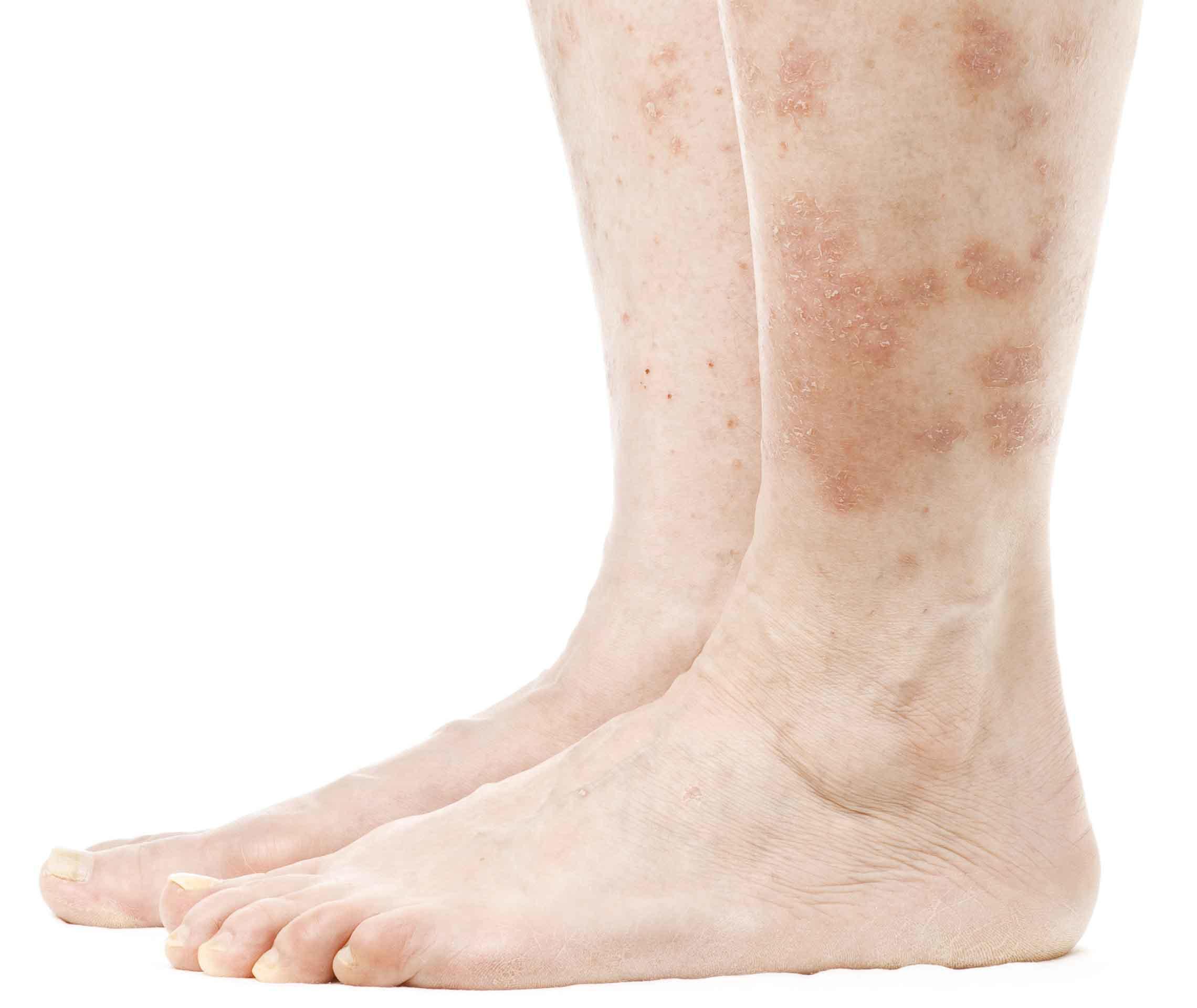 Psoriasis vulgaris