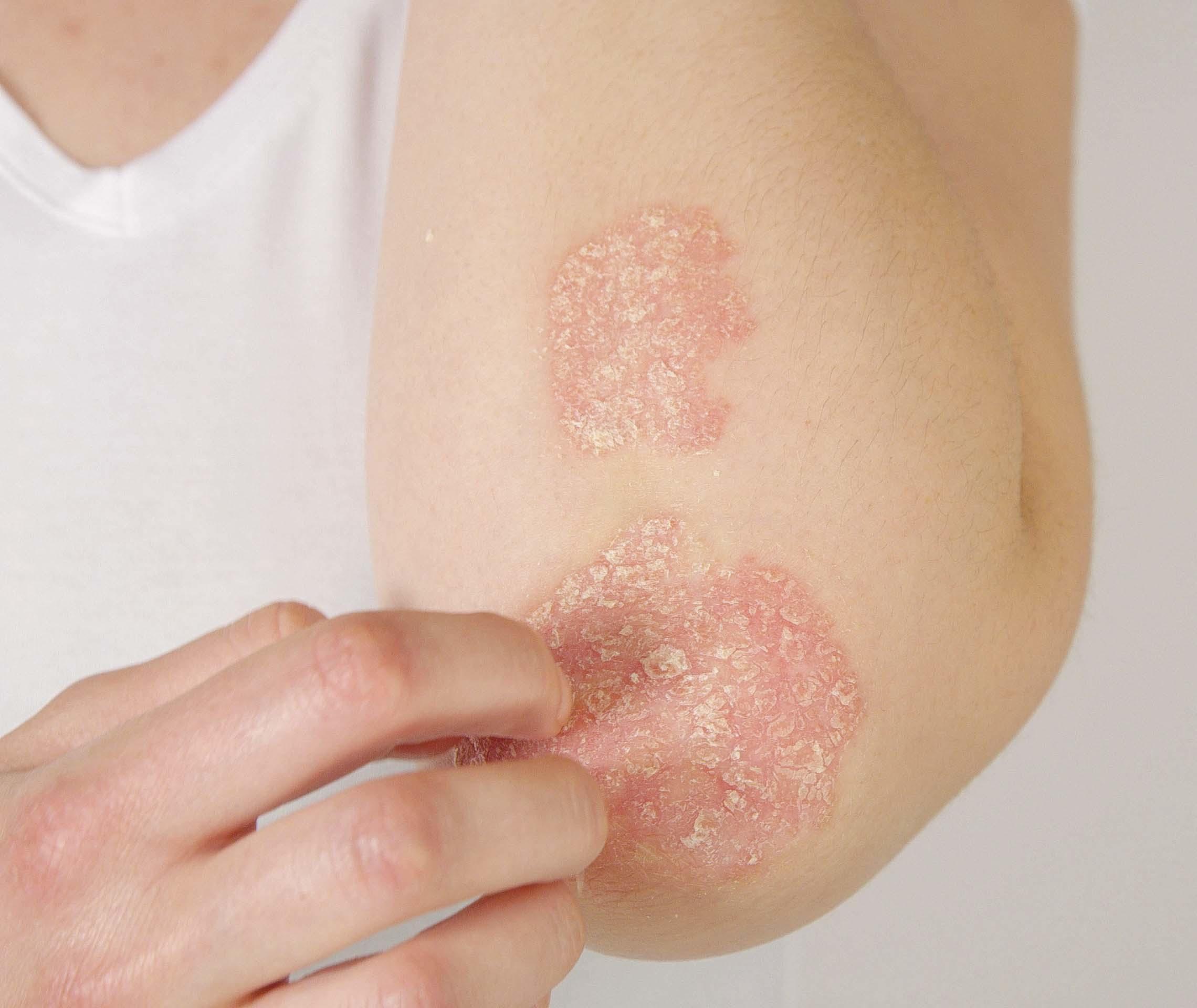 Psoriasis Schuppungen am Ellenbogen