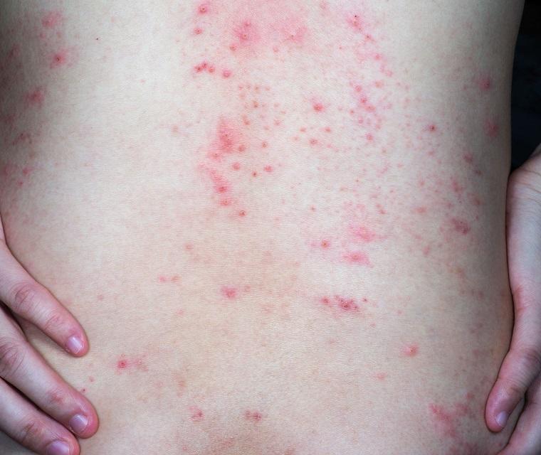 PSORIASIS GUTTATA