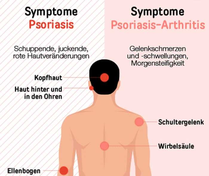 Psoriasis Ursachen Gene Ausloser Ansteckung Psoriasis Info