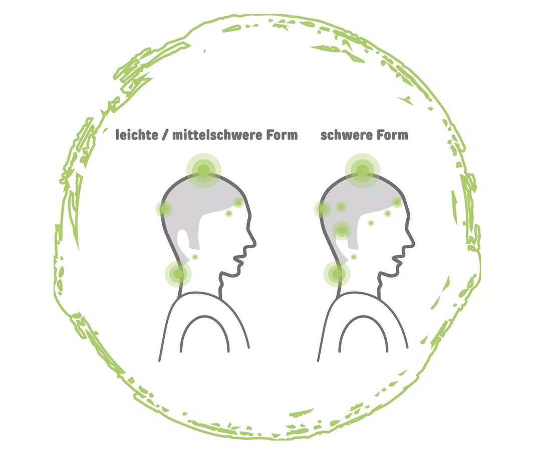 Psoriasis: Kopfhaut Grafik zwei Köpfe mit Psoriasis einer beschriftet mit leichte / mittelschwere Form und einer mit schwere Form