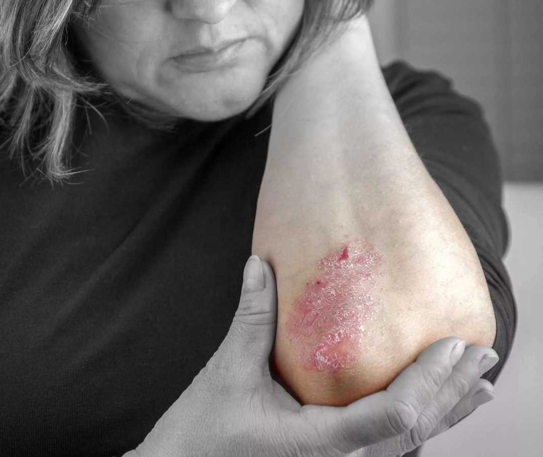 Psoriasis Symptome Die Typischen Anzeichen Psoriasis Info