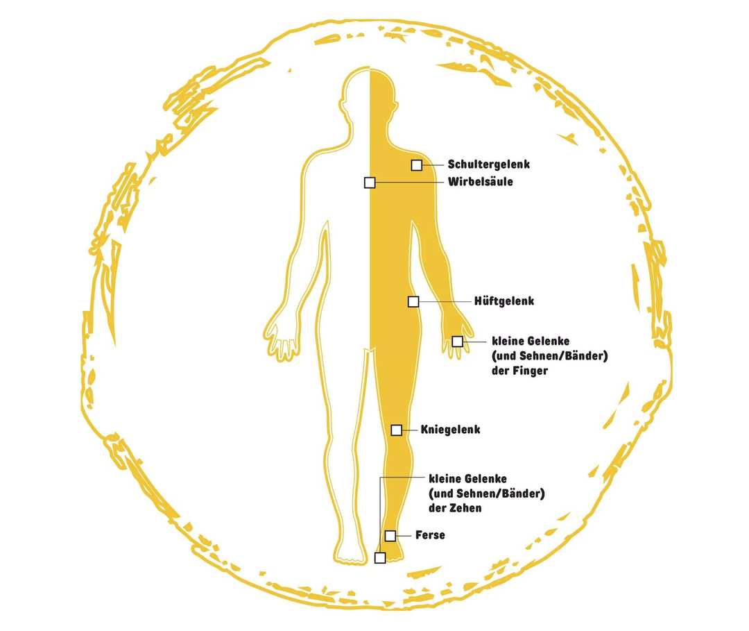Psoriasis Symptome Die Typischen Anzeichen Psoriasis Info
