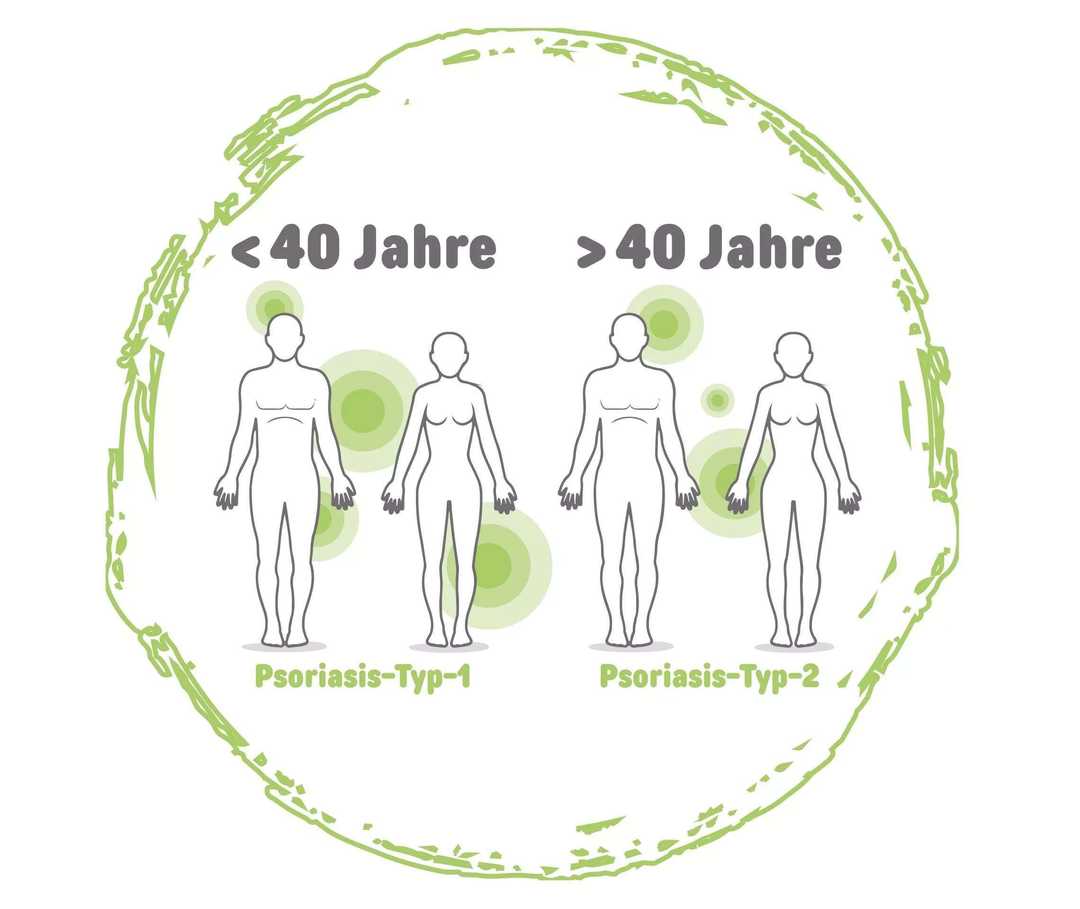 Psoriasis vulgaris: Die Einteilung in verschiedene Typen