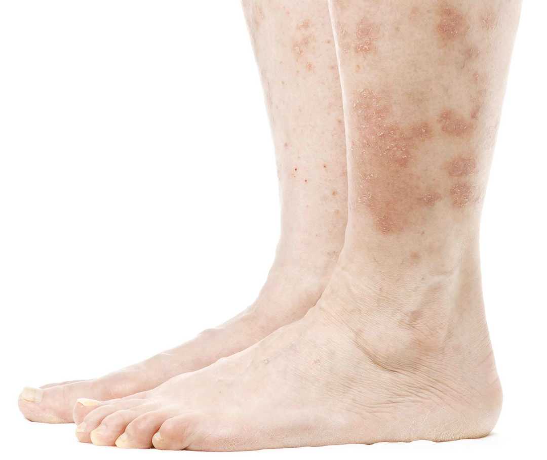 Welche Formen Von Schuppenflechte Gibt Es Psoriasis Info