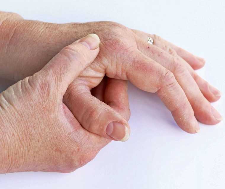 Psoriasis: Diagnose Arthritis Möglichkeiten der Diagnose bei Gelenkbeschwerden