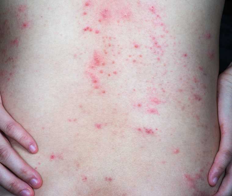 Unter der blutpunkte haut kleine Blutplättchenmangel und