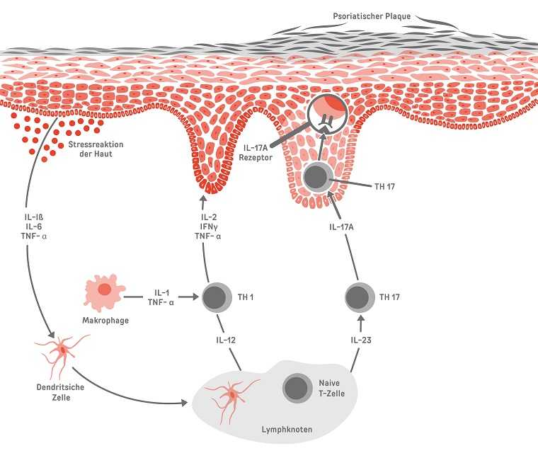 Psoriasis: Therapie mit Biologika Psoriasis-Therapie mit Biologika